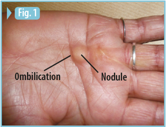 Maladie de Dupuytren nodule souligné par une ombilication